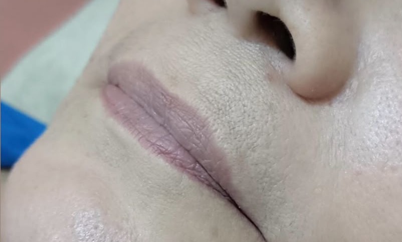 Antes do procedimento de Preenchimento Labial no Instituto GDA