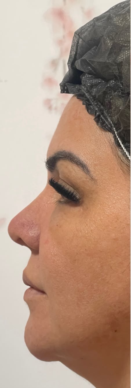 Antes do procedimento de Perfiloplastia no Instituto GDA